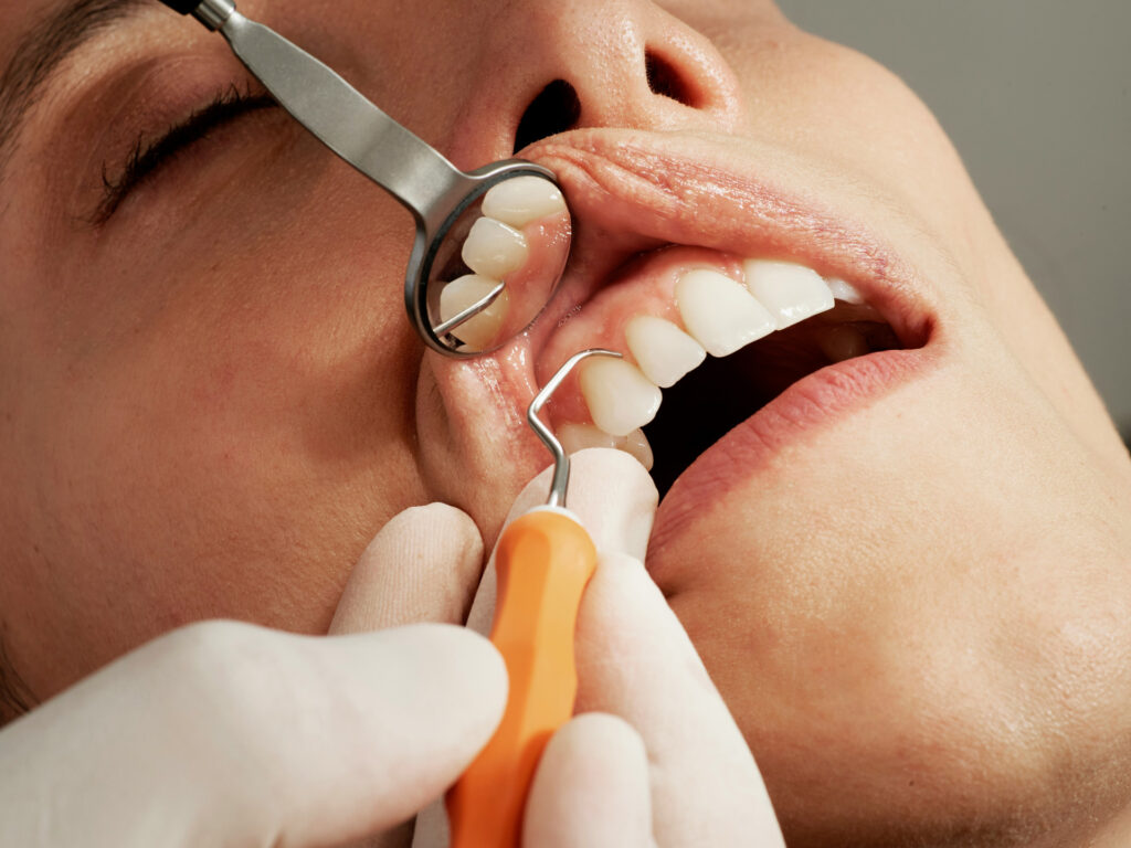 donna dal dentista con fistola gengivale