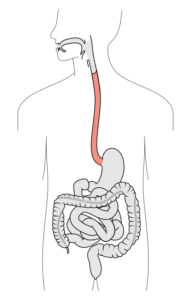 reflusso gastroesofageo succhi gastrici foto2